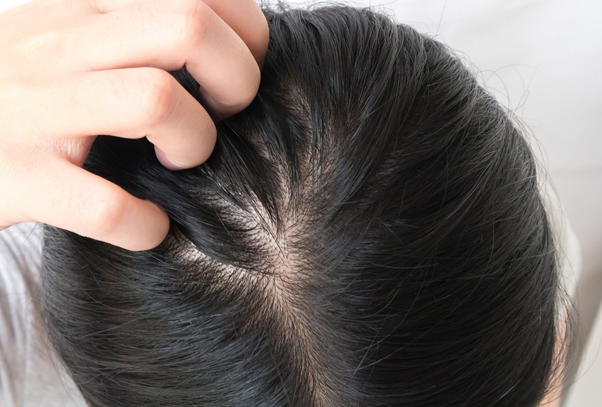 Itchy Scalp Causes Treatment When To See A Doctor