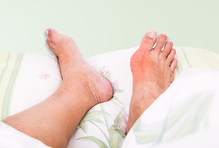 How To Ease A Gout Attack Treatment And Home Remedies