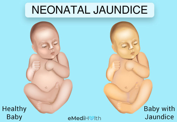 Neonatal Jaundice 