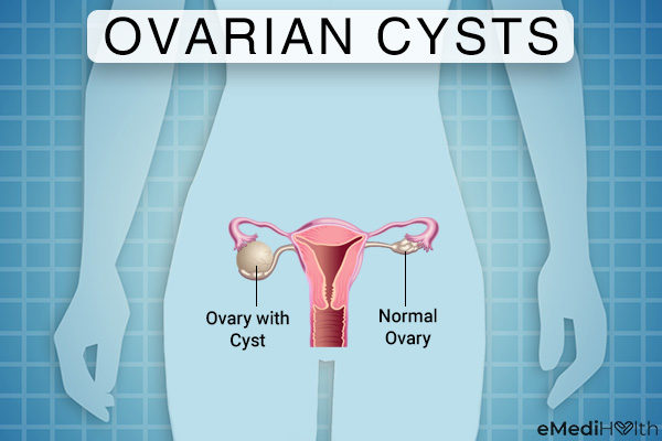 Cyst ovarian 10 Warning