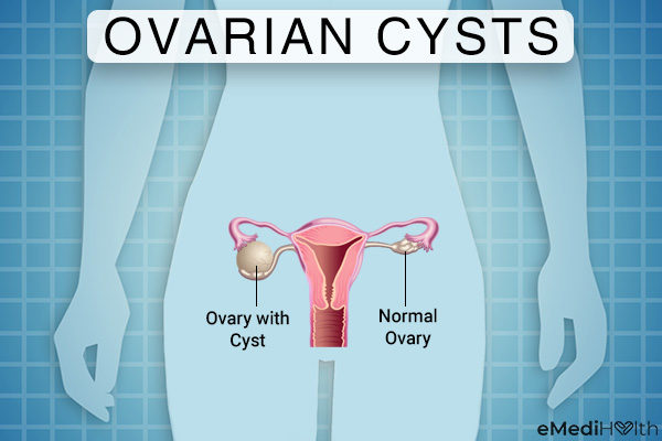 ovarian cyst rupture