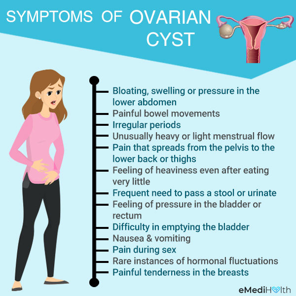 Sypmtoms of ovarian cyst