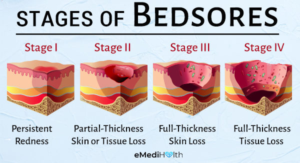 stages of bedsore