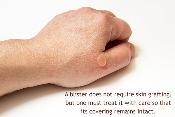 is skin grafting required for blisters?