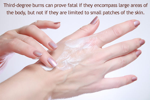 third-degree burns can prove to be fatal