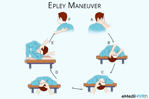 Diagram Of Epley Maneuver For Vertigo