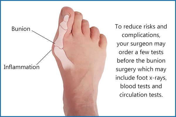 risks involved in bunion surgery