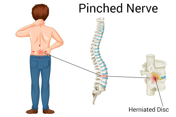 symptoms of a pinched nerve