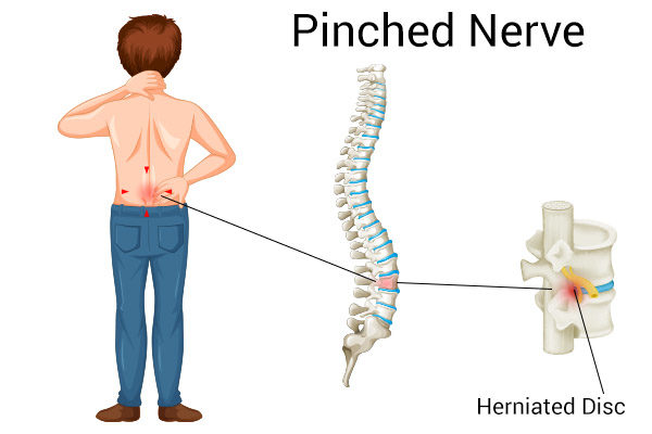 Pinched Nerve Physical Therapy Chiropractic Chart Ubicaciondepersonas 