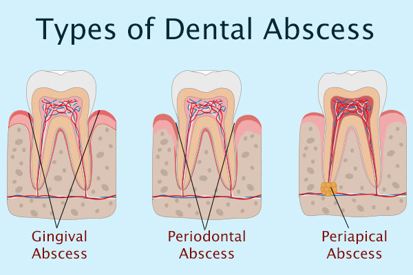 types of tooth abscess