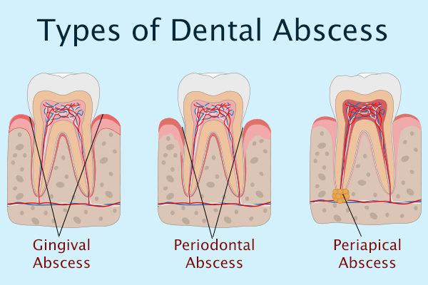 Tooth Abscess Causes And How Long Does It Take To Heal 8761