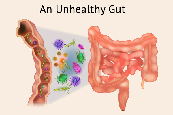 common causes of an unhealthy gut