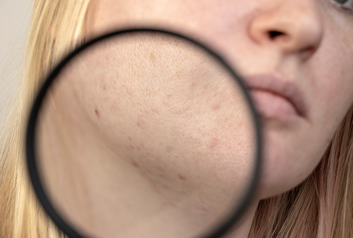 Dark Spots On Face Causes Symptoms Medical Treatment