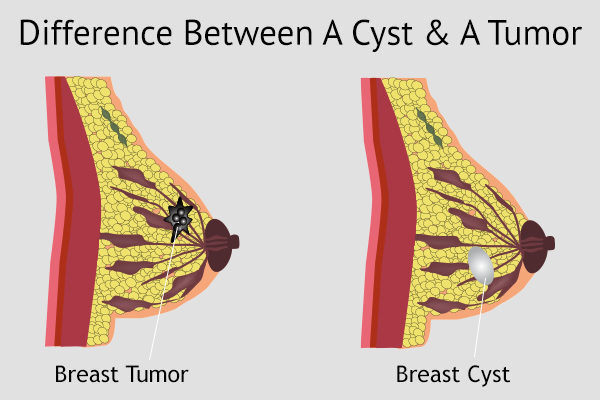 differences between breast tumor and breast cyst