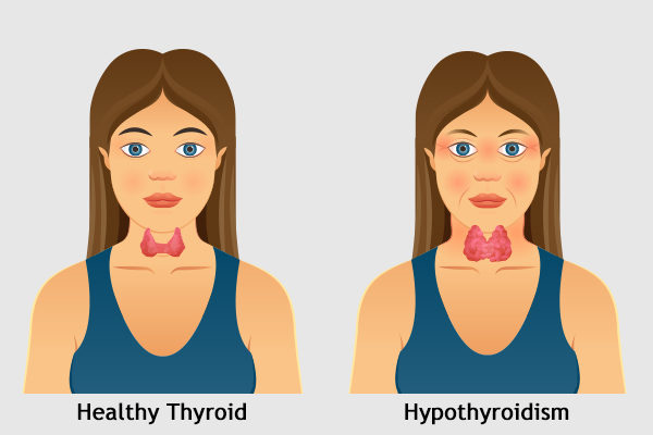 what causes hypothyroidism?