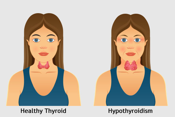 hypothyroidism before and after face