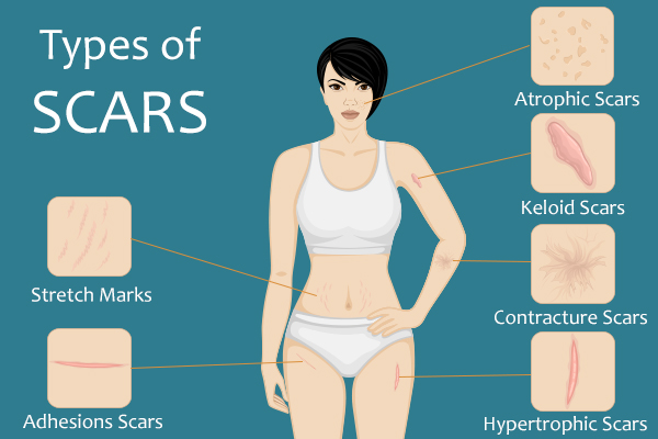 7 Types Of Scars Causes Symptoms And Treatment 8221