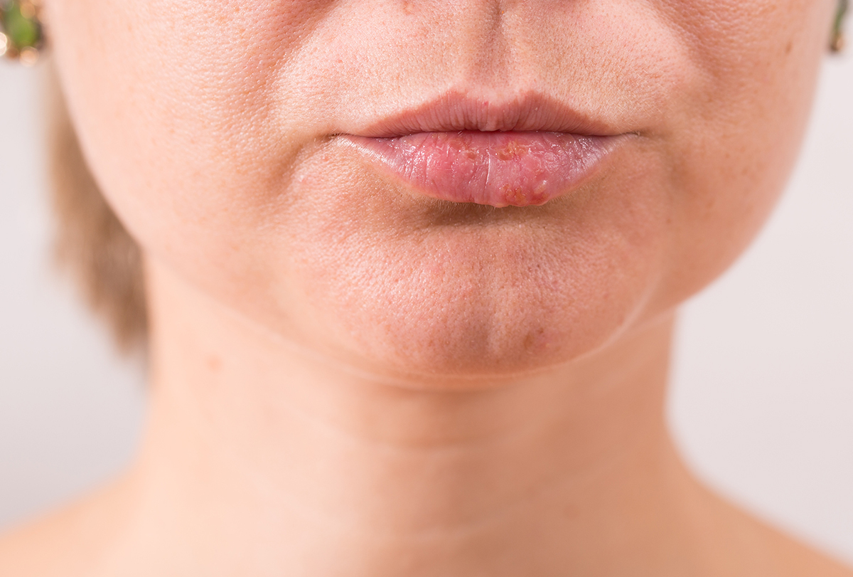 why-do-i-have-a-bump-on-my-lip-healthnord