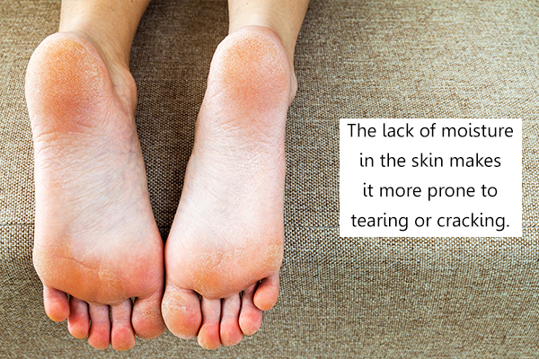 what causes cracked heels?