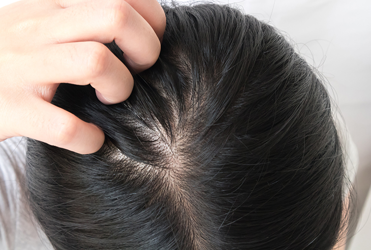 Itchy Scalp: Causes, Treatment, and When to See a Doctor
