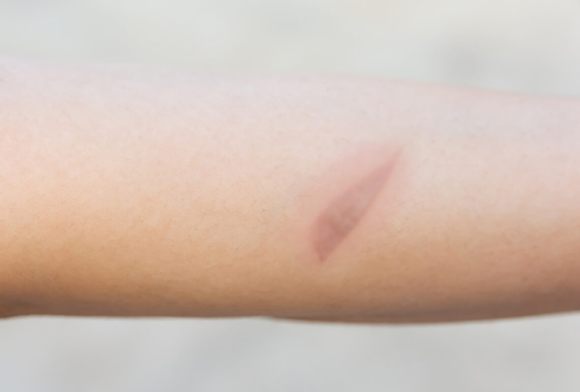 second degree burn scars