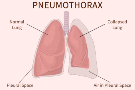pneumothorax lung sounds