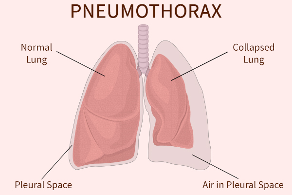 pneumothorax-collapsed-lung-causes-and-how-to-treat-it