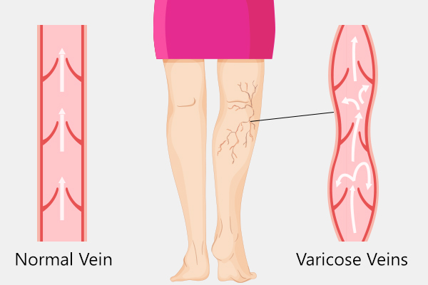 what causes varicose veins?