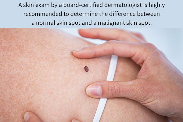 differences between normal and malignant skin lesions