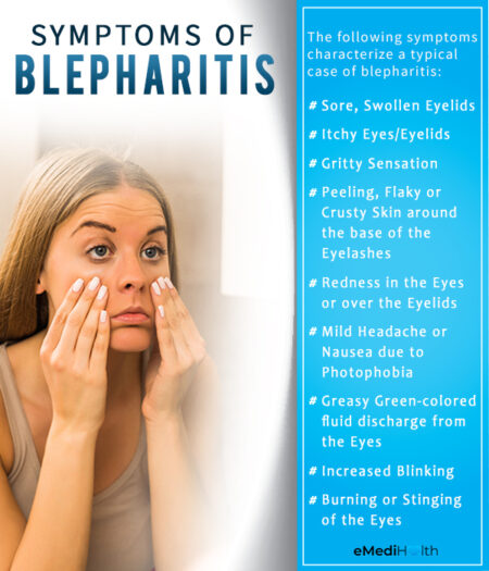 Blepharitis Types Causes Symptoms And Medical Treatment 