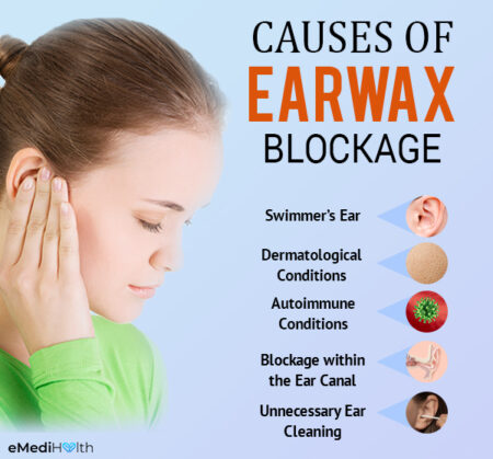 cleaning impacted ear wax
