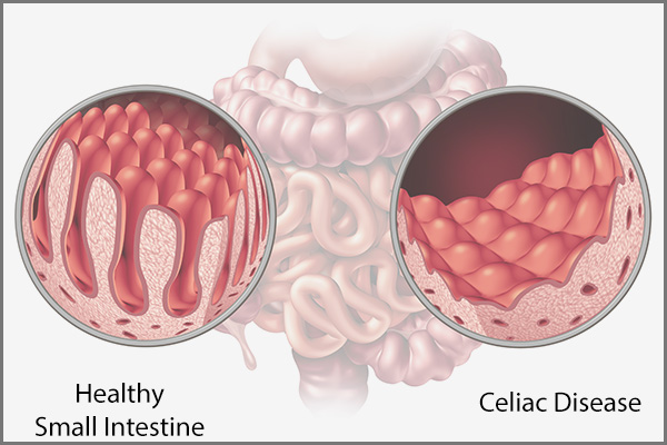 how celiac disease affects the small intestine?