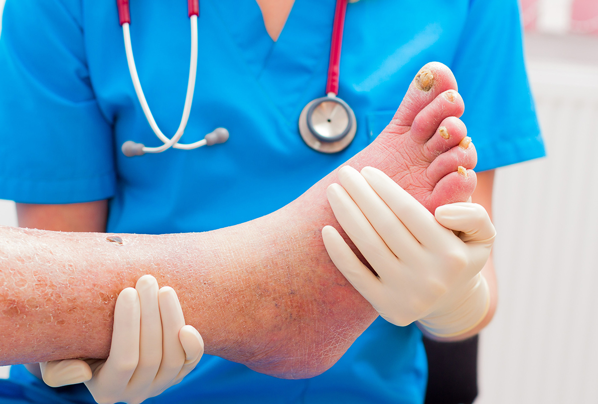 What Are Diagnostic Tests For Cellulitis