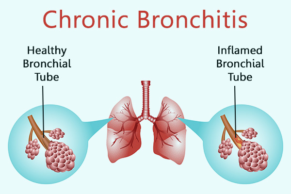 what is chronic bronchitis?