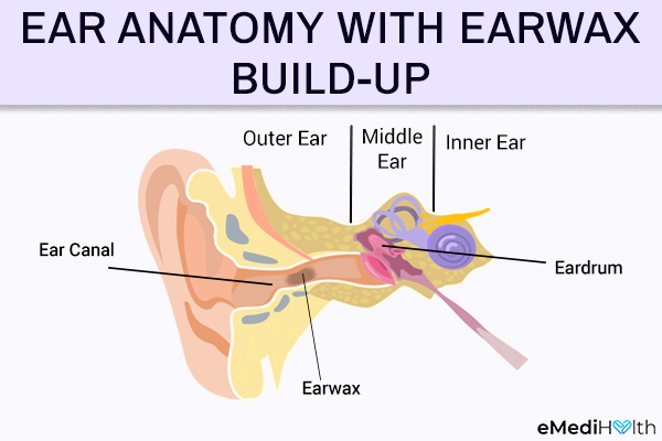 What Does Ear Wax Look Like In Ear Canal