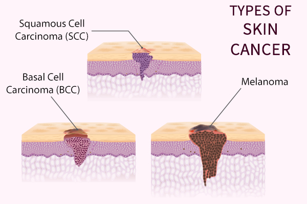 types of skin cancer