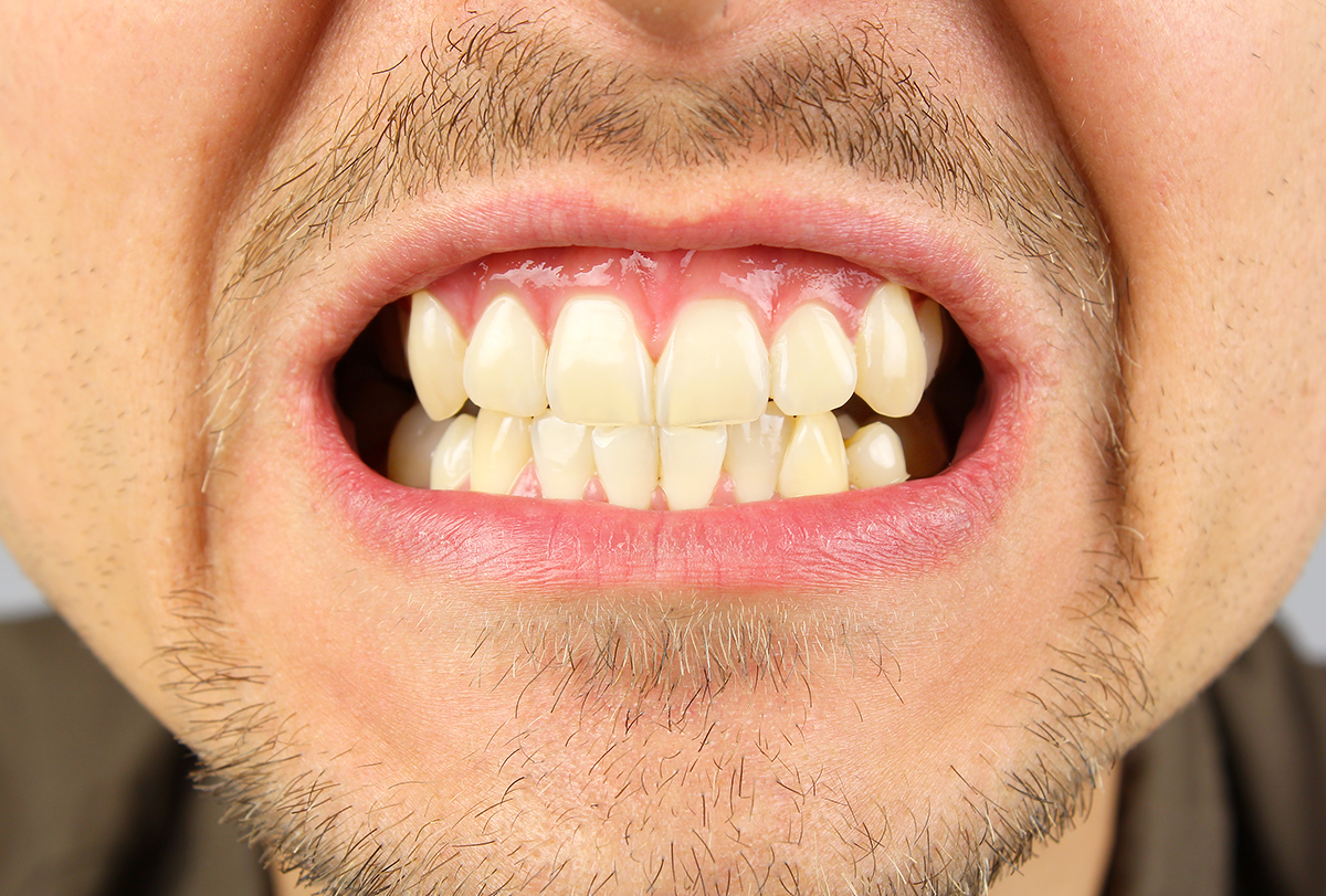 How to Manage Teeth Grinding (Bruxism) eMediHealth