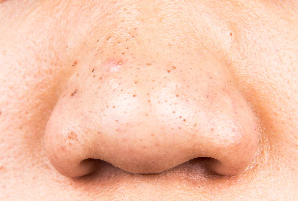 How to Get Rid of Blackheads at Home - eMediHealth