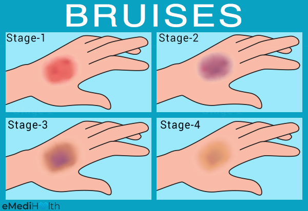 what does a bruise looks like?