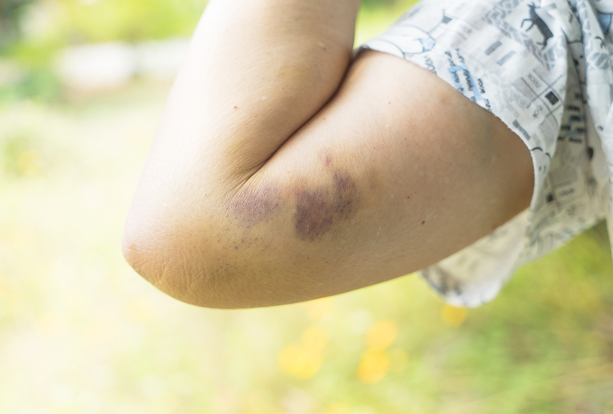 Possible Reasons And Risk Factors For Bruises EMediHealth