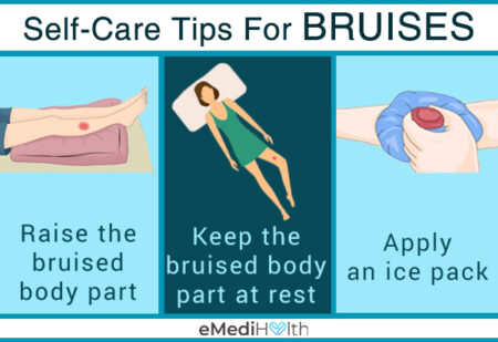 bruises hot or cold compress