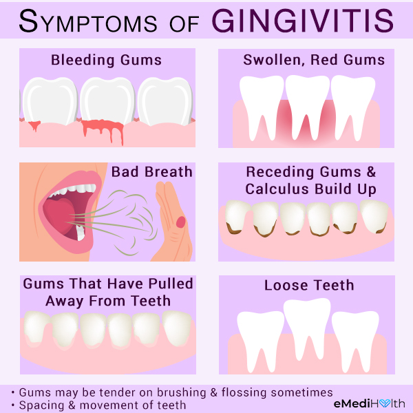 signs and symptoms that indicate gingivitis