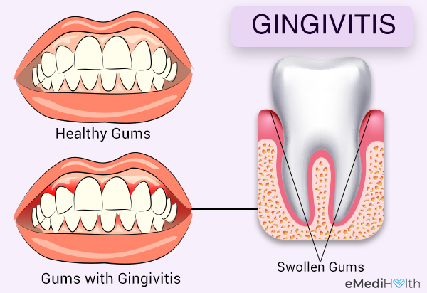 what is gingivitis?