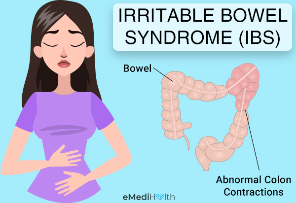 Que tomar para el colon irritable