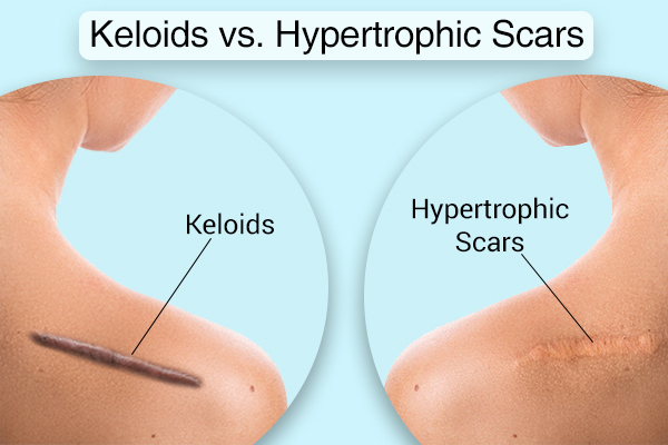 keloids versus hypertrophic scars