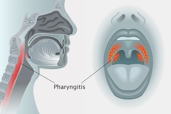 Acute Pharyngitis Causes Symptoms Diagnosis And Treatment