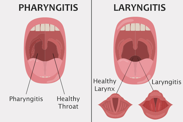 pharyngitis versus laryngitis