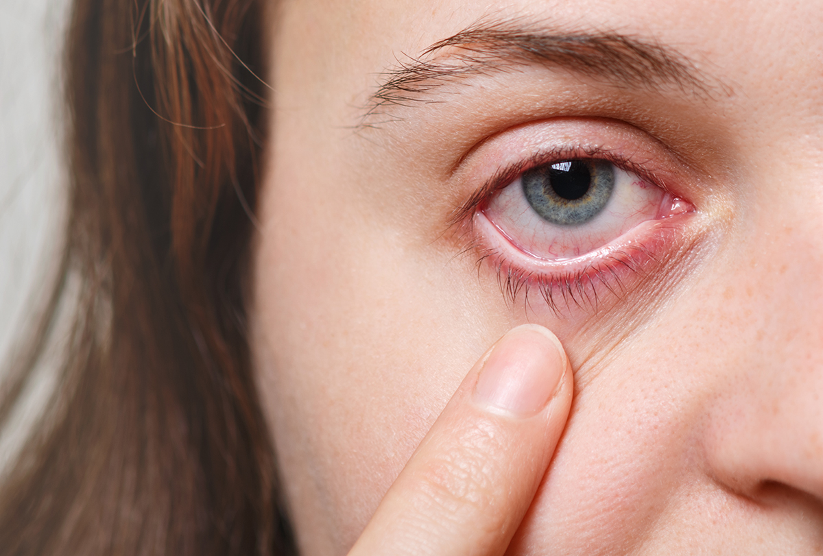 at-home remedies to cure pink eye