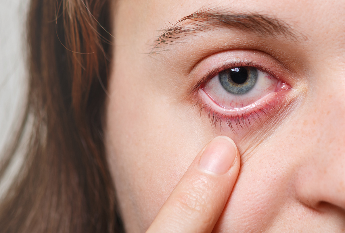 How to Soothe Pink Eye at Home eMediHealth