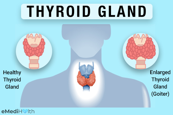 common causes of hyperthyroidism